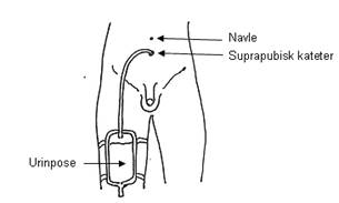Ehandbok Suprapubisk Kateter Spk Voksne Pasientinformasjon